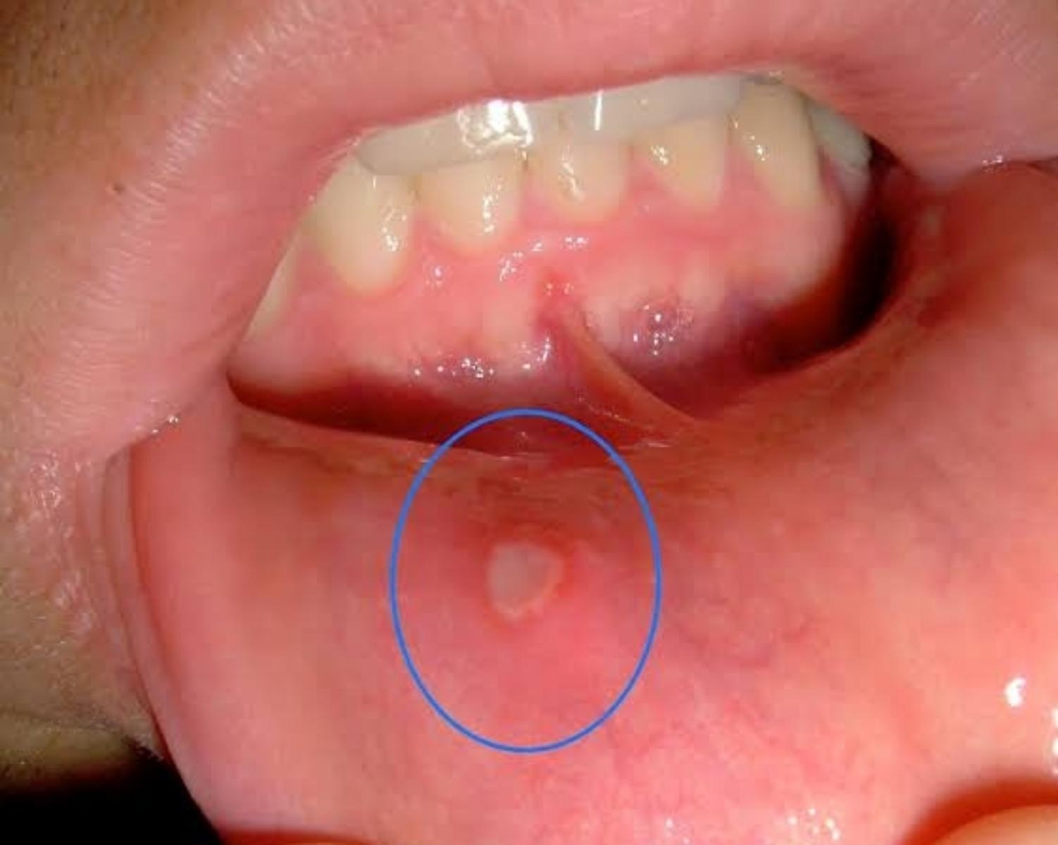 Mouth ulcers