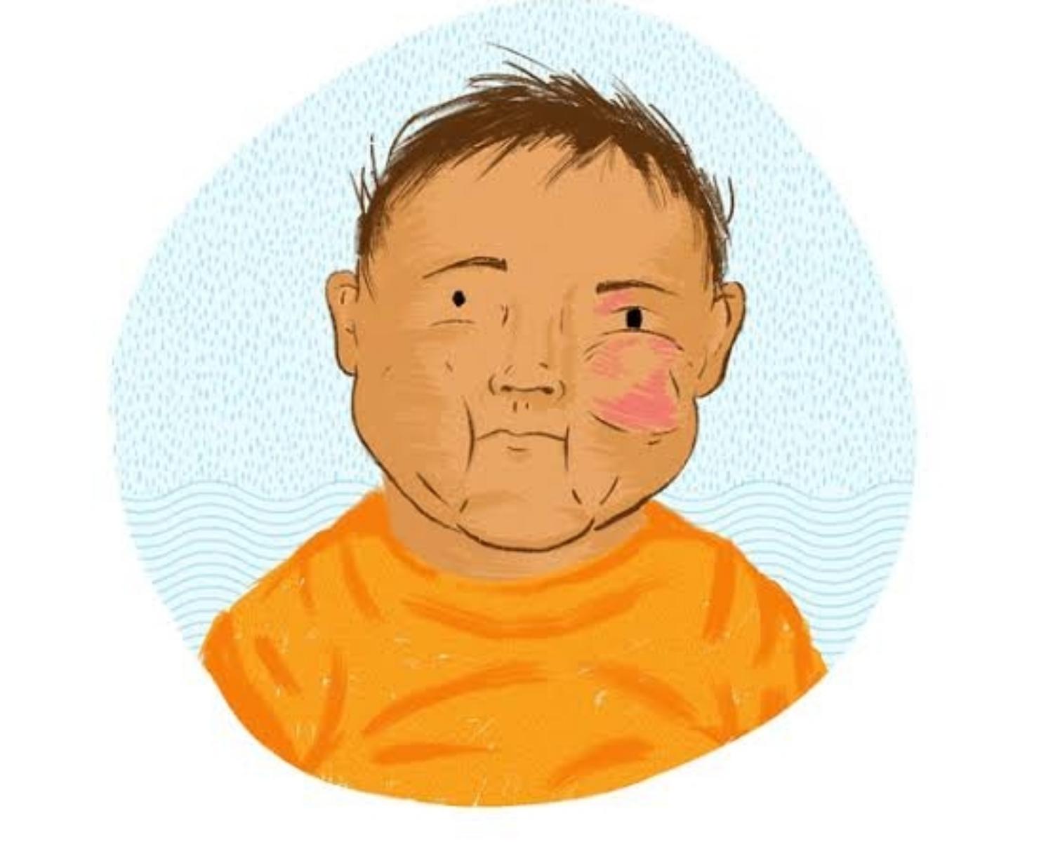 Familiarising with allergic reactions-