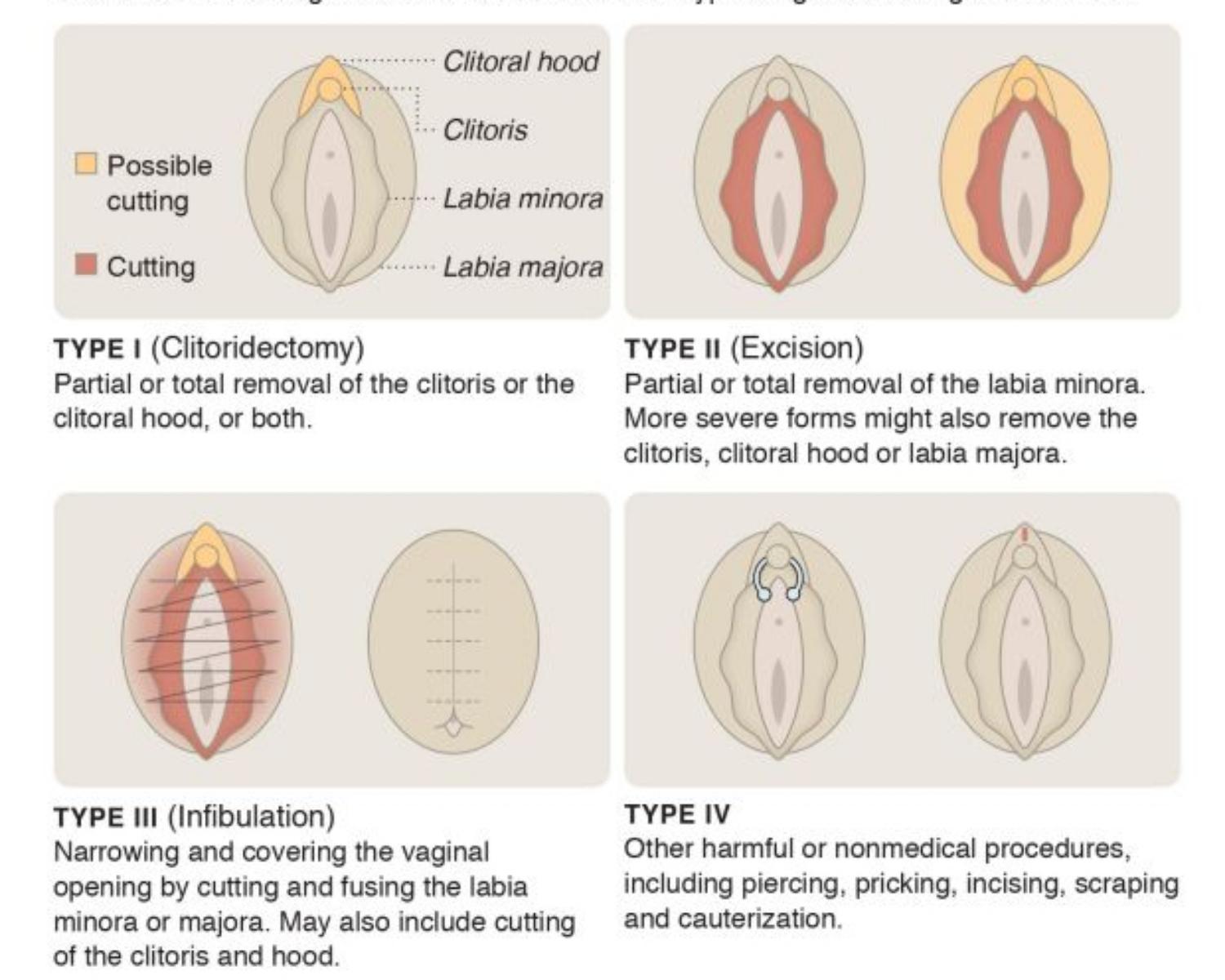 General consensus on childhood genital mutilation